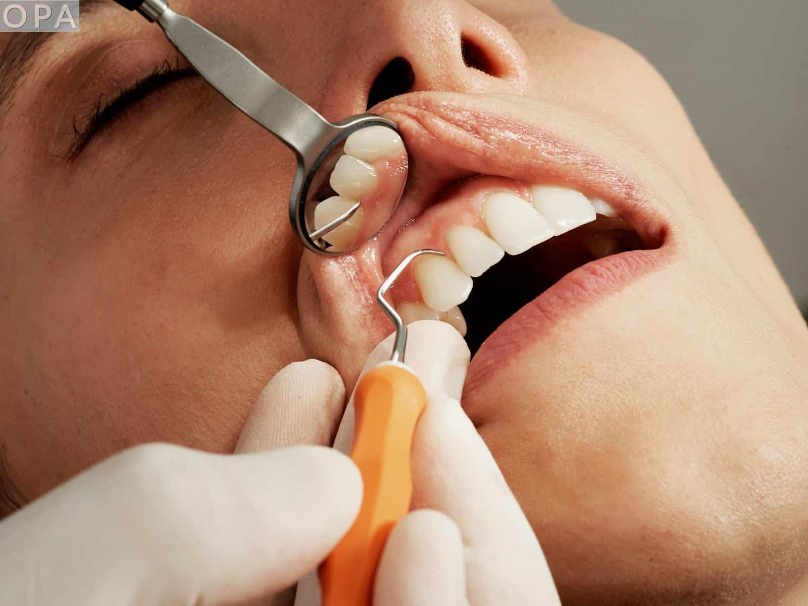 Ortodoncia invisible vs brackets: qué opción conviene según cada caso