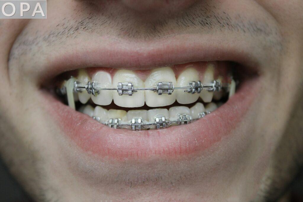 Ortodoncia invisible vs brackets